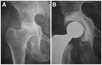 This diagnostic image consists of two side-by-side anteroposterior (AP) radiographs of the hip, comparing preoperative pathology with postoperative results. Panel A illustrates Grade II protrusio acetabuli, a deformity characterized by the medial migration of the femoral head beyond the ilio-ischial (Kohler's) line, often associated with rheumatoid arthritis. There is visible joint space narrowing and subchondral sclerosis consistent with secondary osteoarthritis. Panel B displays the same hip following a Total Hip Replacement (THR). The image shows a prosthetic construct comprising a radio-opaque femoral stem, a modular femoral head, and an acetabular cup. The reconstruction demonstrates the restoration of the anatomical center of rotation lateral to Kohler’s teardrop. This was achieved through the surgical use of a medial bone graft (impacted morselized bone) to address the medial wall deficiency and provide a stable base for the acetabular component. The radiographic comparison highlights the transition from a debilitating pelvic deformity to a corrected prosthetic alignment designed to restore joint biomechanics and weight-bearing function.