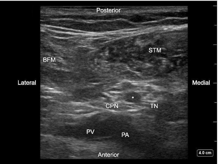 This transverse ultrasound image depicts the popliteal fossa, highlighting the anatomical arrangement for a sciatic nerve block. The imaging shows a 'honeycomb' echotexture characteristic of peripheral nerves. The tibial nerve (TN) is positioned medially and the common peroneal nerve (CPN) laterally, just distal to the sciatic nerve bifurcation. Within the paraneural sheath between these two nerves, a distinct hypoechoic, round arterial structure (marked with an asterisk) is visible. Muscular landmarks include the biceps femoris muscle (BFM) located laterally and the semitendinosus muscle (STM) positioned posteriorly and medially. Deep (anterior) to the neural structures, the popliteal artery (PA) and popliteal vein (PV) are identified, with the vein situated lateral to the artery. The image serves as an educational reference for regional anesthesia, emphasizing the importance of identifying anatomical variants, such as this inter-neural artery, to avoid vascular puncture during ultrasound-guided nerve blocks.