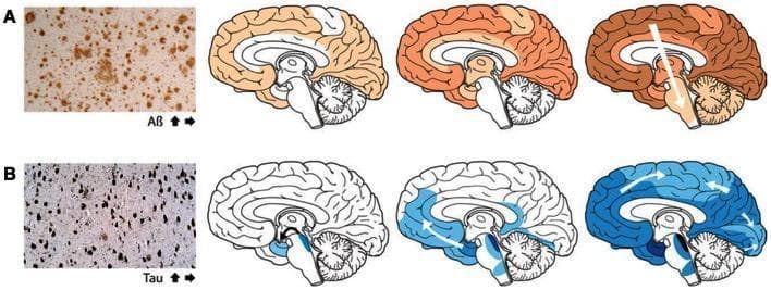 This medical illustration depicts the characteristic spatial progression of protein aggregation in Alzheimer's disease. The figure is divided into two primary rows: Row A focuses on ̢-amyloid (A̢) plaques, and Row B focuses on Tau-associated neurofibrillary tangles. Each row begins with a histological micrograph showing the morphology of the protein deposits, followed by a sequence of three sagittal brain diagrams illustrating staging. In Row A (orange shading), A̢ plaques are shown to initiate in the neocortex, subsequently spreading to the allocortex and deeper subcortical structures, following a top-down and outer-to-inner progression. In Row B (blue shading), neurofibrillary tangles are shown starting in the locus coeruleus and transentorhinal regions of the brainstem and medial temporal lobe, then progressing through the limbic system to the wider neocortex. White arrows indicate the direction of spread, emphasizing the stereotyped spatiotemporal evolution of AD pathology. This diagram serves as a pathophysiology resource for understanding Braak staging and the involvement of neuronal transport in the spread of proteopathic seeds.