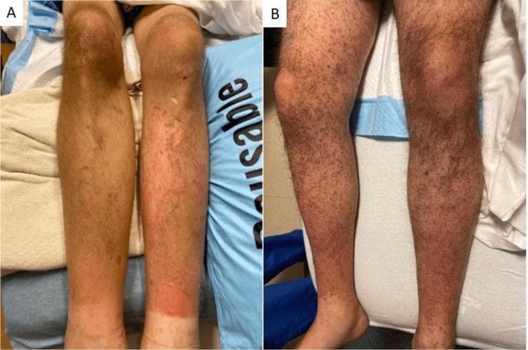 Clinical photograph of bilateral lower extremities from two different patients demonstrating dermatologic manifestations of Vitamin C deficiency (scurvy). Panel A shows extensive non-blanching perifollicular purpura and petechiae across the pretibial areas and calves. There is a large, confluent erythematous rash on the lower right calf, suggestive of ecchymosis or secondary inflammation. Panel B displays diffuse, folliculocentric hyperkeratotic papules and petechiae extending from the shins to the thighs. Characteristic 'corkscrew' hairs (coiled, malformed hair shafts) are visible within the hyperkeratotic follicles. These findings are classic pathognomonic signs of scurvy, resulting from impaired collagen synthesis and capillary fragility. The images serve as an educational resource for identifying nutritional deficiency-related skin disorders in vulnerable populations.