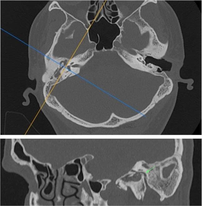 This medical visual consists of two panels showcasing Multidetector Computed Tomography (MDCT) of the temporal bone for anatomical assessment of the facial nerve (CN VII). The top panel displays an axial thin-section MDCT scan at the level of the skull base, featuring blue and orange planning lines used to generate multiplanar reformats. The bottom panel displays a reformatted sagittal view derived from the axial data. This sagittal section clearly illustrates the intraosseous course of the facial nerve canal within the temporal bone. Key anatomical landmarks demonstrated include the tympanic segment, the sharp angulation at the second genu, and the descending mastoid (vertical) segment. Surrounding structures such as the mastoid air cells, tympanic cavity, and the relationship of the facial canal to the posterior wall of the external auditory canal are visible. The green arrow specifically highlights the region of the second genu. This type of multiplanar reformatting is clinically essential for preoperative planning in otologic surgery and for evaluating facial canal dehiscence or traumatic injury.