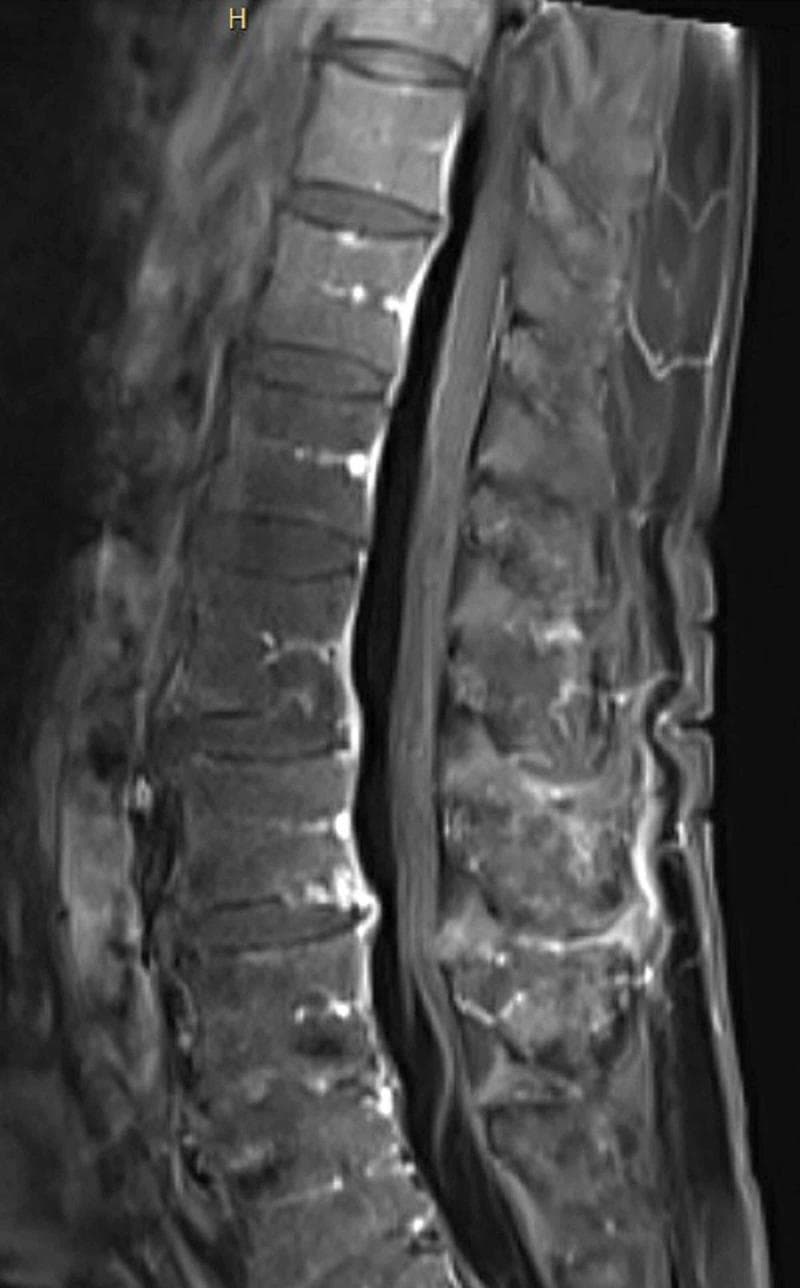 This diagnostic image is a sagittal T1-weighted post-contrast MRI of the lumbar spine. It illustrates a clear view of the vertebral bodies, intervertebral discs, and the spinal canal. The primary finding is the diffuse, linear enhancement of the nerve roots of the cauda equina, which appear hyperintense (bright) relative to the surrounding hypointense cerebrospinal fluid (CSF). This enhancement extends along the nerve roots within the thecal sac. The vertebral marrow exhibits heterogeneous signal intensity. Such visual evidence of nerve root enhancement on contrast-enhanced MRI is a characteristic radiologic finding in inflammatory polyneuropathies, such as Guillain-Barré Syndrome (GBS). The image demonstrates the clinical significance of using gadolinium-enhanced imaging to identify blood-nerve barrier breakdown in the evaluation of acute flaccid paralysis.
