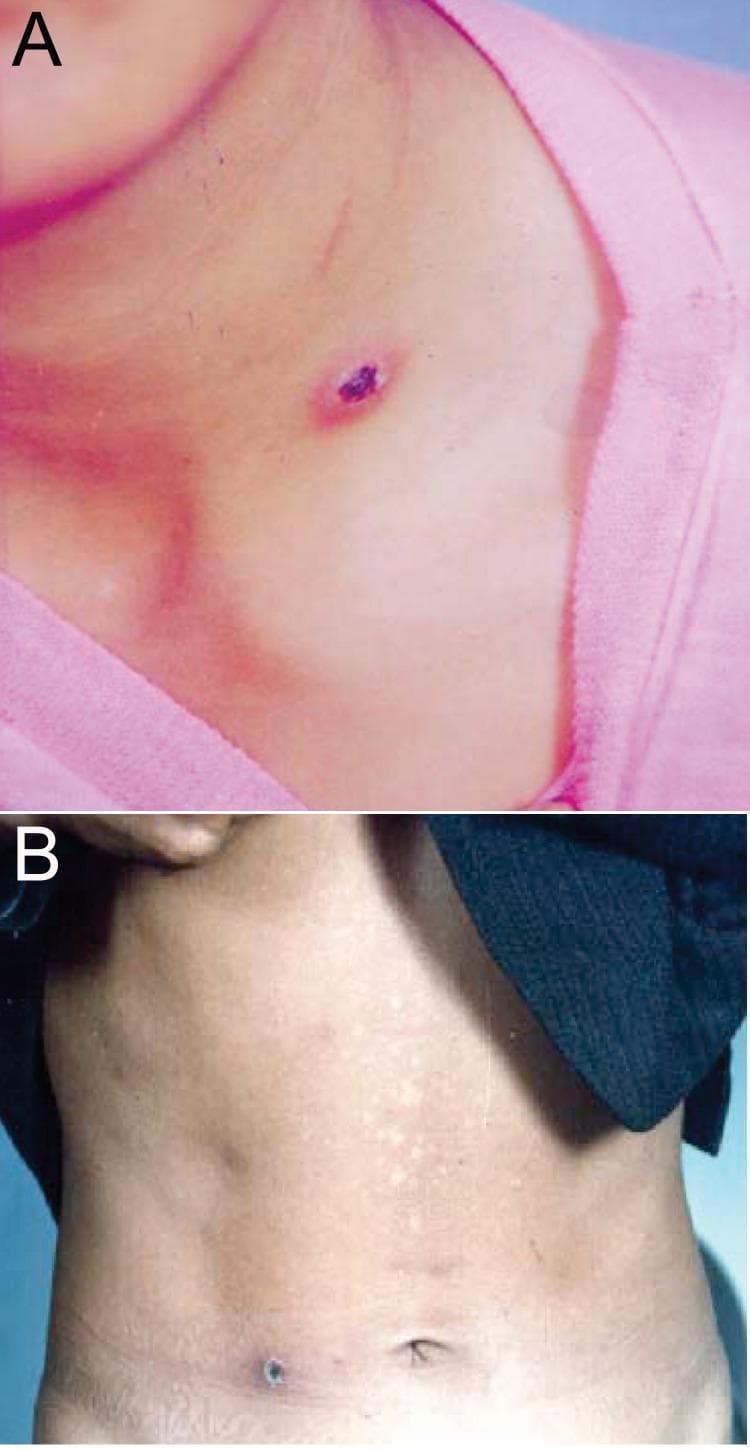 This clinical photograph consists of two panels (A and B) demonstrating the characteristic skin eschars of scrub typhus, caused by Orientia tsutsugamushi. Panel A shows an anatomical view of the neck and upper chest of a patient. A single, small, necrotized lesion is visible, characterized by a dark purple to black central crust (eschar) with an oval-to-irregular shape. The lesion is surrounded by a faint erythematous halo, suggesting localized inflammation at the chigger bite site. Panel B shows a second patient with an eschar located on the waist/lower abdominal region. This lesion is similarly dark and crusty but appears slightly more circular. The surrounding abdominal skin shows subtle mottling or hypopigmentation. These images serve as classic diagnostic examples of the primary lesion found in rickettsial diseases, particularly scrub typhus, which often appears in areas where clothing is tight or skin is thin. The clinical significance of these visual findings is their role as a hallmark diagnostic sign during the acute phase of infection.