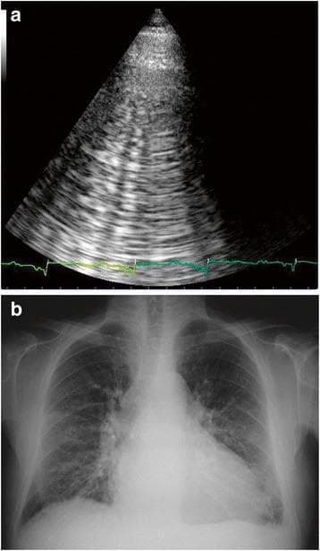 This dual-panel image displays diagnostic findings characteristic of Acute Heart Failure (AHF). Panel 'a' is a lung ultrasound using a phased-array transducer, showing multiple vertical, hyperechoic 'B-lines' (comet-tail artifacts). These laser-like lines originate from the pleural line and extend to the bottom of the screen, indicating interstitial edema. A synchronous ECG tracing is visible at the bottom. Panel 'b' is a posterior-anterior chest X-ray demonstrating cardiomegaly, evidenced by an enlarged cardiac silhouette. There is increased bronchovascular marking and bilateral interstitial opacities consistent with pulmonary venous congestion and edema. Prominent hilar regions and hazy lung fields further support the diagnosis of AHF. This comparison highlights the correlation between bedside sonographic artifacts (B-lines) and classic radiographic signs of cardiogenic pulmonary congestion, serving as a teaching tool for rapid differentiation of dyspnea in an emergency or critical care setting.