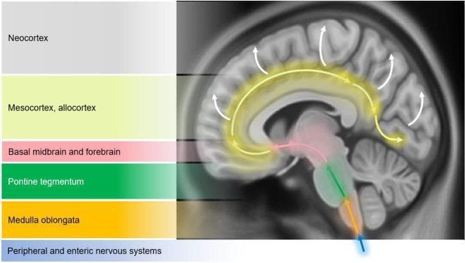 This medical schematic diagram illustrates the Braak staging model of alpha-synuclein pathology progression in Parkinson's disease. The image features a sagittal view of the human brain overlaid with color-coded regions and directional arrows to depict the caudo-rostral spread of Lewy bodies and Lewy neurites. The progression is categorized into six stages starting from a blue arrow representing the peripheral and enteric nervous systems. The pathological ascent is shown sequentially through the medulla oblongata (orange), the pontine tegmentum (green), and into the basal midbrain and forebrain (pink), which includes the substantia nigra. From these subcortical structures, yellow arrows indicate the spread to the temporal mesocortex and allocortex (light yellow), eventually reaching the neocortex (grey) as shown by white arrows. This visual model highlights how neurodegeneration moves from the lower brainstem to higher cortical regions, correlating with the clinical transition from motor symptoms to cognitive dysfunction and dementia.