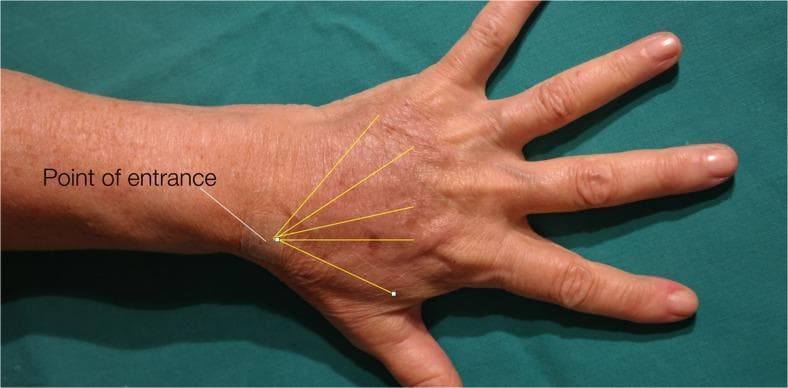 This clinical photograph illustrates the surgical planning for hand rejuvenation via fat grafting (lipofilling). The image shows the dorsum of an aged hand, characterized by skin flaccidity, fine rhytids (wrinkles), loss of subcutaneous fat volume, and visible extensor tendons and dorsal veins. A single 'Point of entrance' is labeled at the level of the distal wrist/proximal metacarpal region. Radiating from this point are several yellow overlay lines that represent the intended vector pathways for cannula insertion and fat distribution. These lines fan out across the dorsal metacarpal spaces toward the base of each digit and the thumb, following the anatomical distribution where volume restoration is needed. The educational focus is on the procedural technique for uniform fat placement in the aesthetic and reconstructive treatment of the senile hand, demonstrating a centralized injection port to minimize trauma while maximizing coverage.