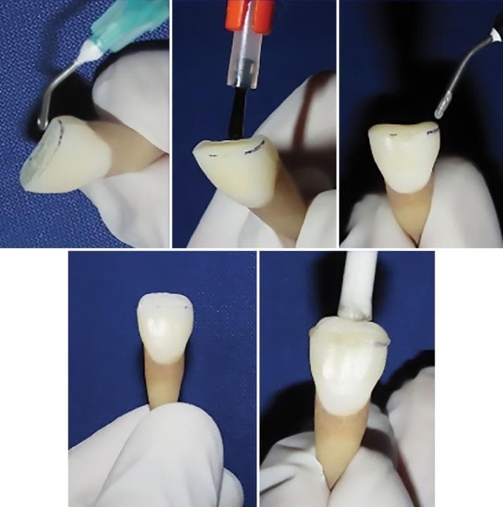 A series of five intraoral clinical photographs documenting the step-by-step dental fragment reattachment procedure on a maxillary central incisor specimen. The images illustrate the following sequence: 1) Application of an etching agent (typically 37% phosphoric acid) to the fractured enamel surface using a green-hubbed syringe with a metal bent needle tip. 2) Application of a dental bonding agent using a small disposable applicator brush. 3) Dispensing flowable composite resin from a syringe onto the prepared fracture site. 4) The initial approximation of the separated tooth fragment to the apical tooth portion. 5) The final reattachment, where the fragment is stabilized with a white placement instrument during light-curing. The tooth specimen features a visible dark horizontal line marking the intended fracture site 3 mm from the incisal edge. This educational sequence demonstrates restorative techniques for managing crown fractures in pediatric and general dentistry, focusing on the adhesive protocol required to restore anatomical integrity and function using composite resin materials.