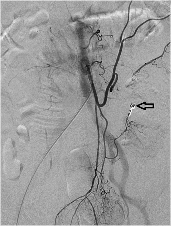 A digital subtraction angiogram (DSA) of the abdominal and pelvic vasculature, specifically targeting the inferior mesenteric artery (IMA) and its distal branches. The image displays the arterial tree as dark, contrast-filled branching structures against a grayscale background. An arrow points to a distinct area of intervention at the arcade between the left colic artery and the sigmoid artery. This area contains a radiopaque, high-density cluster of spring-like metallic coils and amorphous gel foam cubes, indicating a successful transarterial embolization (TAE) of a previously identified pseudoaneurysm. The embolization material forms a dense, occlusive mass to prevent further extravasation. The surrounding pelvic arterial anatomy, including the iliac vessels and sigmoid branches, remains visible with normal contrast filling. This diagnostic image demonstrates the post-procedural appearance of an emergency interventional radiology procedure for gastrointestinal hemorrhage control.