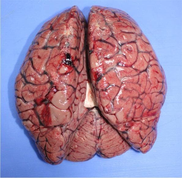 This clinical photograph displays a superior-posterior view of a human brain at autopsy, showcasing macro-pathological signs of severe cerebral congestion and edema, secondary to a fatal case of cerebral malaria (Plasmodium falciparum). The cortical surface exhibits a generalized dusky red-to-pink discoloration, characteristic of massive vascular congestion. Significant cerebral edema is evidenced by the marked flattening of the gyri and the narrow, compressed appearance of the sulci. The brain appears enlarged, with visible engorgement of the pial vessels, which are prominent and dark. Focal areas of surface hemorrhage and dusky discoloration are visible, particularly along the left cerebral hemisphere. The cerebellum is visible in the lower portion of the frame, also demonstrating vascular prominence. This image is a key educational resource for understanding the macroscopic manifestations of malaria-related brain injury, highlighting the physiological consequences of parasitized erythrocyte sequestration in cerebral capillaries which leads to increased intracranial pressure and vascular compromise.