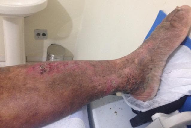 Content Type: Clinical Photograph showing skin manifestations in a patient with chronic lymphedema and recurrent erysipelas. Anatomical Region: Anterior lower leg, ankle, and foot. Findings: The image reveals widespread integumentary changes including diffuse hyperpigmentation (stasis-related browning), patchy erythema (redness), and significant texture irregularities. The skin surface exhibits extensive scaling, dryness, and areas of lichenification or thickening. Specific lesions include a cluster of eroded, raw areas on the mid-anterior leg with associated reddish inflammation and focal dark crusting, suggesting secondary infection or chronic irritation. The distribution of these findings is circumferential and continuous from the mid-calf down to the dorsum of the foot. Clinical Significance: These findings illustrate common dermatological complications of chronic lymphedema, such as stasis dermatitis, fibrosclerosis, and impaired barrier integrity leading to increased risk of recurrent cellulitis. Target Audience: Medical students and dermatology residents focusing on chronic limb edema complications.