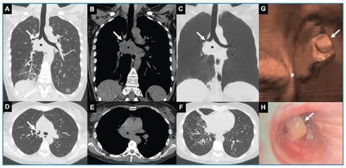 This composite figure presents multi-modal thoracic imaging and endoscopy. Panels A-F show chest CT scans in coronal (A-C) and axial (D-F) planes, utilizing both lung and mediastinal windows. A large, heterogeneous, hypodense subcarinal mediastinal mass/lymph node conglomerate is visible (asterisk), characteristic of necrotic lymphadenopathy. There is an associated endobronchial component (arrow) extending into the right main and intermediate bronchi. Lung window images (A, D, F) demonstrate secondary parenchymal changes in the middle and right lower lobes, including consolidation, subsegmental atelectasis, and centrilobular nodules in a 'tree-in-bud' pattern, suggesting infectious bronchiolitis or endobronchial dissemination. Panel G provides a 3D virtual bronchoscopy reconstruction, while Panel H shows a fiberoptic bronchoscopy view, both highlighting a smooth, polypoid endobronchial lesion (arrow) partially obstructing the right-sided airway. The findings are clinically significant for evaluating pulmonary cryptococcosis or other granulomatous infections causing mediastinal lymphadenitis and airway involvement.