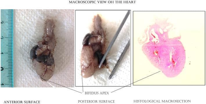 This composite educational image displays the macroscopic and histological examination of a fetal heart specimen, highlighting a rare congenital anomaly known as a bifid apex. The visual is divided into three panels: an anterior surface view, a posterior surface view, and a histological macrosection stained with Hematoxylin and Eosin (H&E). The anterior view includes a metric ruler for scale, illustrating the small size of the 19–20 week gestational age heart. Both gross photographs clearly demonstrate a notched or 'bifidus apex,' where the ventricular tip is divided into two distinct points. The middle panel shows the posterior aspect being manipulated with surgical forceps. The third panel provides a low-magnification histological macrosection, correlating the external bifid morphology with the internal myocardial structure. Clinically, this image illustrates morphological variations in fetal cardiac development and provides visual evidence of a bifid apex associated with potential myocardial architectural disorders such as noncompaction or hypertrophic cardiomyopathy.