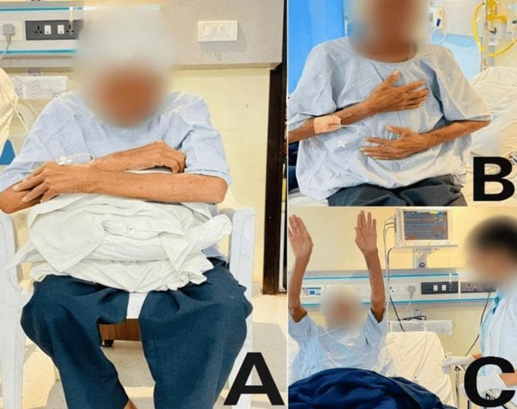 Clinical photograph showing a series of three respiratory physiotherapy interventions (labeled A, B, and C) for a patient in a hospital setting. Panel A depicts the forward-leaning position, with the patient seated and leaning over a supportive pillow to alleviate dyspnea by optimizing accessory muscle use. Panel B shows the patient in a semi-recumbent position performing diaphragmatic breathing exercises, indicated by the hand placement on the chest and abdomen to monitor breath depth and abdominal excursion. Panel C illustrates thoracic expansion exercises, with the patient seated and arms fully abducted and elevated to enhance chest wall mobility and lung volume. The environment includes standard medical equipment such as a wall-mounted cardiac monitor, bedside rails, and a medical professional assisting with the rehabilitation protocol. These interventions are typically used in post-operative or pulmonary rehabilitation contexts to address pleural effusion, atelectasis, and reduced respiratory capacity.