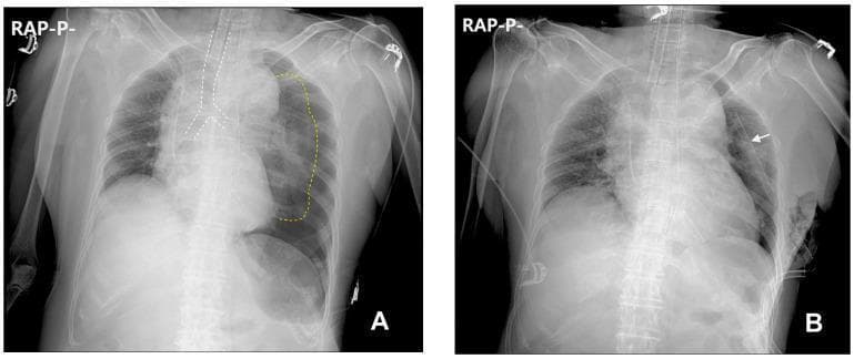 This figure presents two comparison chest radiographs (Anteroposterior view) demonstrating the presentation and resolution of a tension pneumothorax. Image A displays a massive left-sided tension pneumothorax. Key diagnostic features include a profound visceral pleural edge of the left lung (outlined with yellow dotted lines) showing total collapse toward the hilum, a significant mediastinal shift to the right (trachea highlighted by white dotted lines), and caudal displacement (flattening/depression) of the left diaphragm. These findings indicate high intrapleural pressure compromising venous return. Image B shows the clinical status following emergency intervention. A chest tube (indicated by a white arrow) is correctly positioned in the left hemithorax. The previously collapsed left lung has re-expanded, filling the hemithorax. The mediastinum and trachea have returned toward the midline, and the diaphragmatic contours show improved symmetry. This comparison illustrates the life-saving decompression of a tension pneumothorax and the restoration of normal thoracic anatomy through needle thoracostomy and tube drainage.