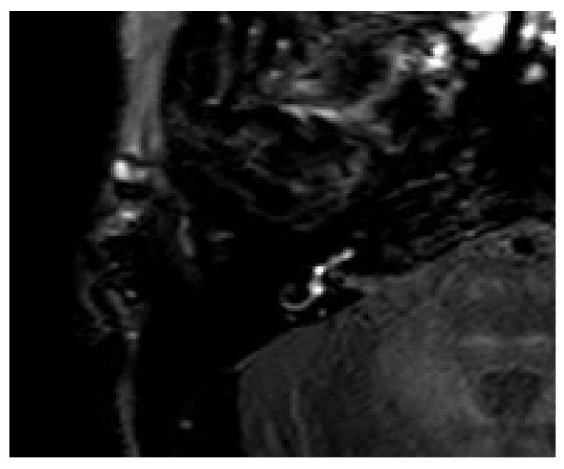 This diagnostic image is a 4-hour delayed post-contrast 3D Fluid-Attenuated Inversion Recovery (3D-FLAIR) MRI sequence of the temporal bone and inner ear. The axial view highlights focal areas of hyperintense signal within the right inner ear structures, specifically localized to the vestibulum and the basal turn of the cochlea. This pathological contrast enhancement indicates increased blood-labyrinth barrier permeability or fluid accumulation, often associated with conditions such as labyrinthitis or perilymphatic fistula (PLF). The surrounding anatomical regions, including the adjacent brainstem and cerebellum, appear with normal signal suppression characteristic of the FLAIR technique, emphasizing the high-intensity signals in the vestibular and cochlear compartments. This modality is highly sensitive for detecting subtle inner ear pathology in patients presenting with acute sensorineural hearing loss and vertigo.