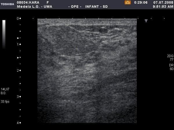 This diagnostic ultrasound image demonstrates the anatomy of a human lactating breast in the 12 o'clock position following breastfeeding. The imaging captures the superficial skin and subcutaneous layers overlying the mammary parenchyma. The skin appears as a thin, hyperechoic line at the superior margin, maintaining uniform thickness. The underlying glandular tissue exhibits a generally homogeneous echotexture with a notable reduction in thickness and overall echogenicity post-feed. Several localized hypoechoic (darker) regions are visible within the parenchyma, particularly in the upper right quadrant, representing fluid-filled structures or small milk ducts. The image provides clinical insight into the physiological changes of the mammary gland during lactation, specifically illustrating how milk removal affects the density and visual appearance of glandular tissue on high-resolution ultrasound. No pathological skin thickening or significant masses are observed.