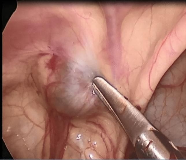 This endoscopic clinical photograph displays a laparoscopic view of the internal inguinal ring (IIR) in a pediatric patient. The image illustrates a Type I spermatic cord hydrocele, characterized by a rounded, grayish, translucent cystic structure located within the inguinal canal area. A metallic surgical grasper is shown clamped onto the cyst wall, demonstrating its location relative to the peritoneum. Crucially, the internal inguinal ring is visually closed, with a smooth peritoneal surface indicating no communication between the hydrocele and the peritoneal cavity. Surrounding tissues show normal surgical anatomy, including pinkish-red membranes, fine vascularization, and the proximity of the spermatic cord structures. This visual serves as a diagnostic reference for classifying non-communicating hydroceles where the processus vaginalis has successfully obliterated at the level of the internal ring.
