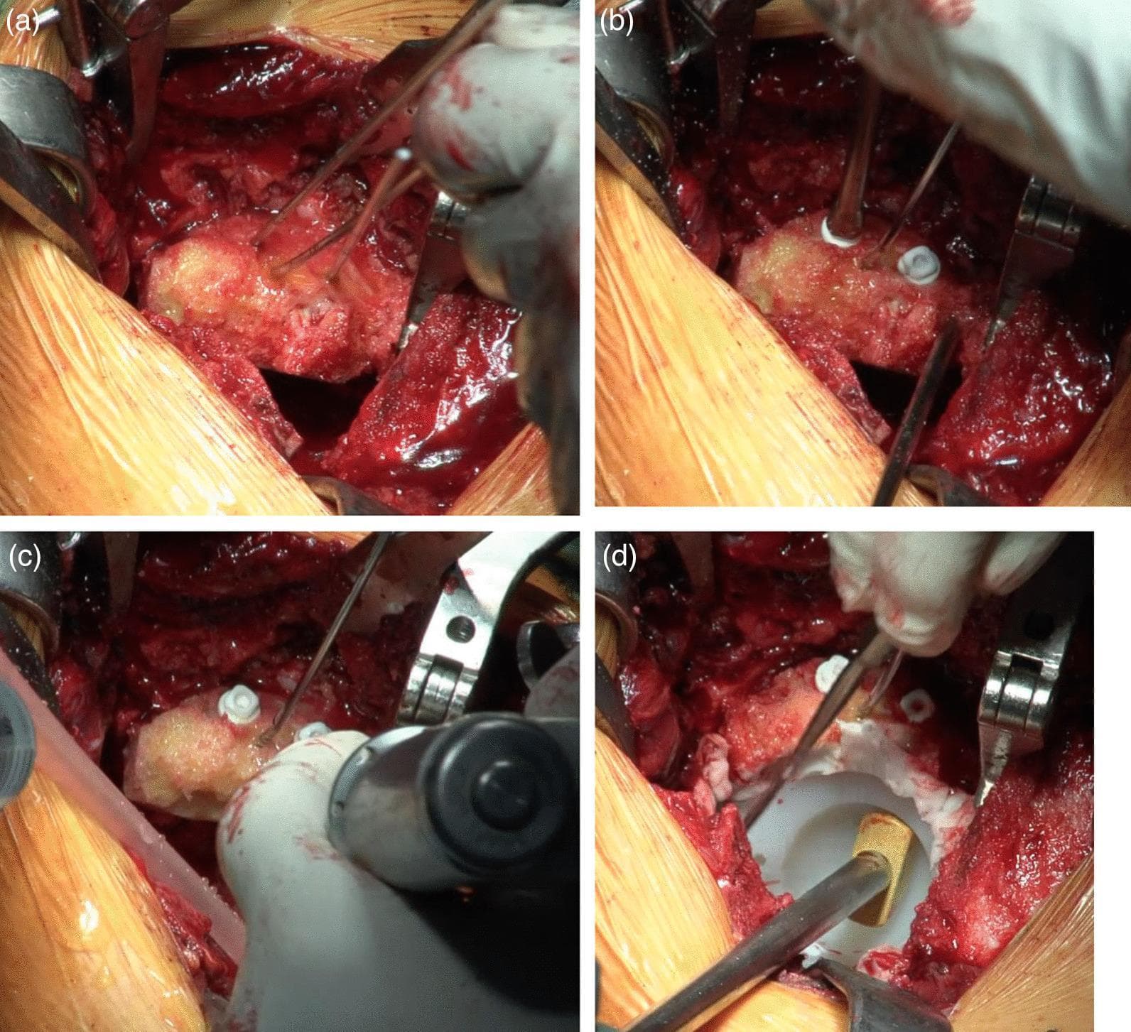 This four-panel series of intraoperative clinical photographs details the surgical technique for structural bone grafting and socket implantation during a cemented total hip arthroplasty (cTHA) for acetabular dysplasia.
Panel (a) demonstrates a roughly hemispherical femoral head autograft being positioned into the superior acetabular defect, secured temporarily with thin metallic Kirschner wires (K-wires). Panel (b) shows the definitive fixation of the graft using bioabsorbable screws (Superfixorb) with white washers, positioned superiorly to allow for subsequent acetabular reaming. A screw insertion tool is visible.
In panel (c), the acetabular bed is re-reamed to create a spherical cavity involving both the native bone and the graft. Panel (d) displays the final implantation of a white highly cross-linked polyethylene (HXLPE) non-flanged socket. The socket is fixed with polymethylmethacrylate (PMMA) bone cement and is being seated with a gold-headed tamping instrument. The bone graft provides structural augmentation to the superior acetabular roof, increasing the contact surface for the cemented implant.