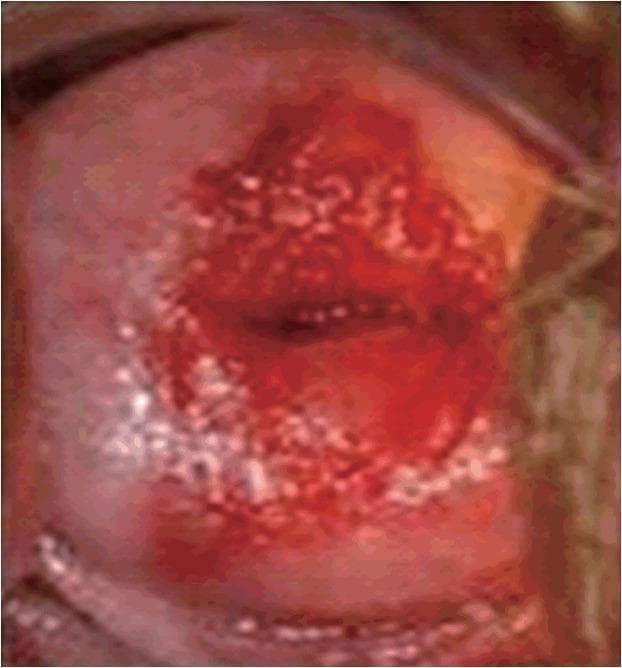 A clinical photograph of a cervix, specifically demonstrating signs of acute cervicitis. The image captures the cervical os and the surrounding ectocervix. The central pathological feature is a prominent, intensely erythematous and friable-looking area concentrated around the cervical opening, characteristic of cervical ectopy or inflammation. The texture in the central region appears raw, irregular, and possibly ulcerated, with deep red saturation. At the periphery of this erythematous lesion, there are multiple small, whitish-yellow spots or raised bumps, which may represent Nabothian cysts or follicular cervicitis findings. The surrounding healthy ectocervical tissue displays a normal pale pink hue and smoother texture. This visual serves as an educational tool for identifying inflammatory gynecological conditions during a pelvic examination, illustrating the distinction between normal squamous epithelium and inflamed columnar epithelium or eroded lesions.