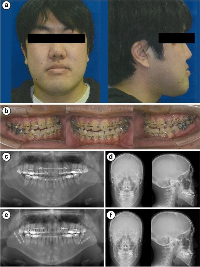 A multi-panel clinical resource documenting a case of mandibular prognathism and its surgical management. Panel (a) presents preoperative frontal and profile facial photographs showing a concave facial profile and prominent lower jaw. Panel (b) contains intraoral photographs displaying bilateral Angle Class III malocclusion, negative overjet (-8 mm), and fixed orthodontic appliances (braces). Panels (c) and (d) provide preoperative diagnostic imaging including a panoramic radiograph and lateral/frontal cephalometric radiograms, highlighting the skeletal discrepancy. Panels (e) and (f) show postoperative imaging one month after bilateral sagittal split ramus osteotomy (SSRO). The postoperative panoramic radiograph (e) reveals surgical fixation hardware (plates and screws) at the mandibular angles bilaterally, and the cephalometric radiogram (f) demonstrates the posterior repositioning of the mandible to achieve improved skeletal alignment. This series illustrates the comprehensive diagnostic and surgical sequence for treating severe jaw deformity and anterior crossbite.