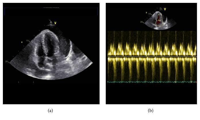 This medical visual consists of two ultrasound images depicting a cardiac evaluation for pericardial effusion. Panel (a) is a transthoracic echocardiogram in the apical four-chamber view. It reveals a significant, circumferential pericardial effusion, characterized by a large, anechoic (dark) space between the epicardium and the parietal pericardium. Despite the volume of fluid, the cardiac chambers, including the right ventricle and right atrium, appear to maintain their structural integrity without obvious diastolic collapse. Panel (b) shows a pulsed-wave Doppler echocardiogram of the mitral valve inflow. The spectral display shows regular, repetitive E and A waves oscillating around the baseline with stable velocities. This normal variation in mitral inflow indicates the absence of significant respiratory-related hemodynamic compromise (pulsus paradoxus) often seen in cardiac tamponade. Together, these images illustrate a clinically significant pericardial effusion without current evidence of right ventricular dysfunction or tamponade physiology.