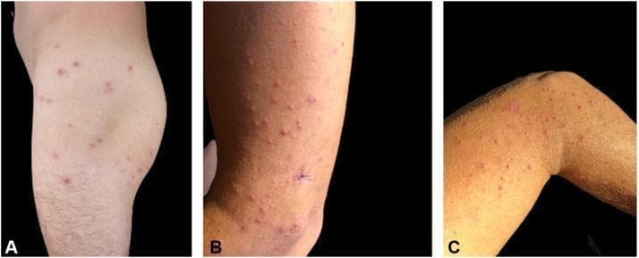 Clinical photographs of the trunk and lower extremities (thigh, knee, and calf) demonstrating a disseminated eruption characterized by multifocal skin lesions. The images show a polymorphous presentation including erythematous papules, yellow-reddish pustules, and shallow, punched-out ulcers. The pustules exhibit a follicular distribution, suggesting an underlying abscessing folliculitis. The ulcers are noted for their depressed centers and thick, red-brown crusting (eschar-like appearance), each surrounded by a distinct halo of erythema. The lesions are scattered across the integument with some areas showing higher density near the knee and thigh. A surgical suture is visible on the calf in Panel B, indicating a biopsy site. This visual presentation is consistent with a generalized infectious folliculitis, specifically Pantoea dispersa-associated folliculitis in the context of environmental exposure.
