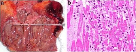 This composite image illustrates the macroscopic and microscopic features of a myocardial rupture. Figure (a) is a clinical autopsy photograph of an opened heart showing a slit-like transmural rupture at the base of the right ventricle. A metallic probe is inserted through the defect to demonstrate the communication. Extensive dark red epicardial hemorrhage is visible adjacent to the rupture site, and the tricuspid valve apparatus is centrally located within the ventricular chamber. Figure (b) is a high-power light microscopy image (H&E stain) of the infarcted tissue. It demonstrates acute myocardial necrosis characterized by hypereosinophilic, disorganized myocytes lacking nuclei (coagulative necrosis) and a dense infiltration of polymorphonuclear leukocytes (neutrophils). These findings are pathognomonic for an acute myocardial infarction in the 48–72 hour range, leading to catastrophic free wall rupture. This visual material is used in pathology and cardiology to teach the mechanical complications of acute myocardial infarction and the histopathological stages of cardiac tissue repair and inflammation.