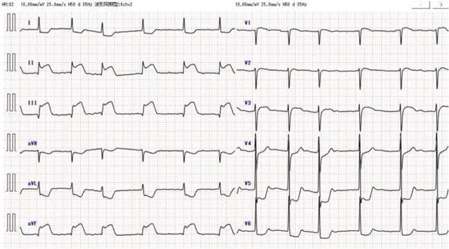 A standard 12-lead electrocardiogram (ECG) demonstrating an acute inferior ST-elevation myocardial infarction (STEMI). The tracing shows significant, convex ST-segment elevation in the inferior leads (II, III, and aVF), consistent with an acute transmural injury in the distribution of the right coronary artery or left circumflex artery. Reciprocal changes are evident as ST-segment depression in the high lateral leads (I and aVL) and the precordial leads (V4 through V6). The rhythm appears to be sinus, and the diagnostic imaging is presented on standard grid paper for the assessment of cardiac electrical activity. This visual is highly relevant for medical education concerning cardiovascular emergencies, acute coronary syndromes (ACS), and the interpretation of reciprocal ECG changes.