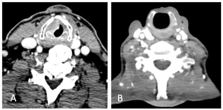 Two side-by-side axial contrast-enhanced CT scans of the neck at the level of the larynx, demonstrating preoperative and postoperative anatomy for laryngeal carcinoma. Image (A) shows the preoperative state with an asymmetric soft tissue mass involving the left vocal fold, causing narrowing of the glottic airway. The thyroid cartilage appears intact but adjacent to the primary lesion. Image (B) displays the postoperative anatomy six months after surgical intervention (likely a partial laryngectomy or supracricoid laryngectomy). Notably, the thyroid cartilage has been removed, resulting in a reconstructed neolarynx with a patent, wider airway compared to the preoperative scan. Both images clearly visualize the cervical vertebrae, posterior neck musculature, and carotid sheath vasculature. This comparison illustrates the radical alteration of laryngeal architecture following oncological resection and surgical reconstruction for throat cancer.