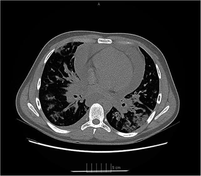 This diagnostic axial CT scan of the chest reveals significant pulmonary and cardiac pathology consistent with severe COVID-19 pneumonia and associated complications. The lung parenchyma shows bilateral, multifocal areas of ground-glass opacities (GGO) and thickened interlobular and intralobular septa, creating a 'crazy-paving' pattern typical of viral interstitial pneumonia. These densifications are distributed across both lungs with a predominant peripheral and posterior involvement. Centrally, the heart is surrounded by a large, circumferential pericardial effusion, visualized as a hypodense fluid layer approximately 26 mm in width encircling the ventricles. The presence of this significant effusion in the context of clinical hypotension and tachycardia suggests cardiac tamponade. This image serves as a high-level educational example of the thoracic complications of SARS-CoV-2, demonstrating both progressive lung damage and life-threatening extrapulmonary cardiovascular involvement.
