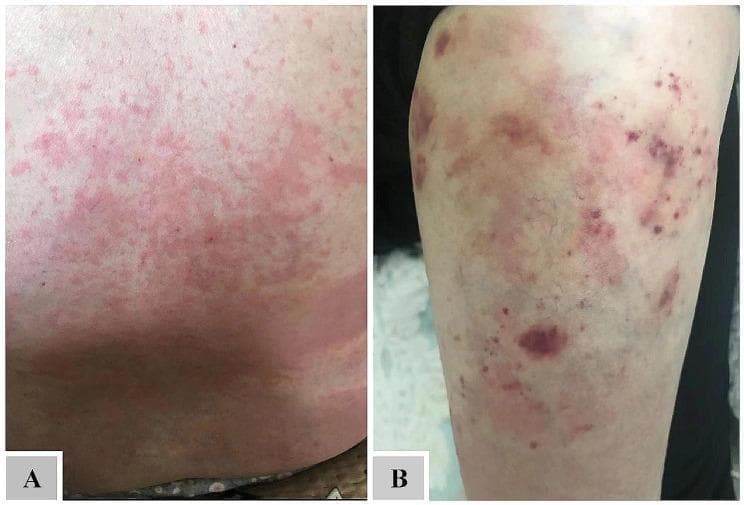 Clinical photographs of cutaneous manifestations in a patient with atypical chronic myeloid leukemia (aCML) and hypereosinophilia. Image A displays a widespread, confluent erythematous maculopapular rash on the torso. The lesions are diffuse, poorly demarcated, and merge to form a mottled, inflammatory appearance consistent with recurrent eosinophilic dermatosis. Image B shows the lower extremity exhibiting multiple purpuric lesions, including pinpoint-sized petechiae and larger, irregular ecchymoses. These lesions present as deep purple to bluish discolorations, indicating blood extravasation into the subcutaneous tissue. The combination of these findings illustrates the dermatologic complications associated with myeloproliferative neoplasms and peripheral eosinophilia, ranging from inflammatory hypersensitivity reactions to microvascular or hemorrhagic manifestations.