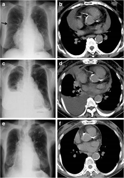A multi-panel medical comparison chart featuring longitudinal chest X-rays (a, c, e) and corresponding axial chest computed tomography (CT) scans (b, d, f) illustrating the clinical progression and resolution of polyserositis associated with Meigs’ syndrome. Panel (a) shows a posteroanterior chest X-ray with cardiac enlargement and a right-sided pulmonary nodule (arrow). The adjacent CT scan (b) confirms a significant, large-volume pericardial effusion. Panel (c) demonstrates clinical progression on X-ray with a large right-sided pleural effusion and blunting of the left costophrenic angle, indicating bilateral involvement. The corresponding CT scan (d) shows a partial decrease in the pericardial effusion but reveals accompanying pleural effusions. Panels (e) and (f) display follow-up imaging eight months after surgical removal of an ovarian fibroma, showing complete resolution of the cardiomegaly, pleural effusions, and pericardial fluid. This clinical series highlights the diagnostic hallmarks of Meigs’ syndrome, characterized by the triad of benign ovarian tumor, ascites, and pleural/pericardial effusions that resolve following tumor excision.