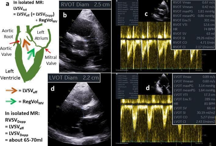 This composite educational graphic illustrates the quantitative assessment of left ventricular (LV) volumes in functional mitral regurgitation (FMR) using echocardiography.
Panel (a) features a pathophysiology diagram of the heart during systole, demonstrating that total left ventricular stroke volume (LVSVtot) is the sum of effective stroke volume (LVSVeff, forward flow to the aortic root) and regurgitant volume (RegVolMV, backward flow into the left atrium).
Panels (b) and (c) display diagnostic ultrasound images and Pulsed-Wave (PW) Doppler spectra for the Right Ventricular Outflow Tract (RVOT). It shows an RVOT diameter of 2.5 cm and a Velocity Time Integral (VTI) of 12.6 cm, calculating an RVSV of 63 ml.
Panels (d) show the corresponding Left Ventricular Outflow Tract (LVOT) measurements, including an LVOT diameter of 2.2 cm and an LVOT VTI of 17.3 cm, resulting in an LVOT SV (LVSVeff) of 66 ml.
The image highlights that in isolated FMR, the right ventricular stroke volume (RVSVDopp) can serve as a proxy for the effective forward stroke volume (LVSVeff). This visual is intended for cardiology learners to understand hemodynamic calculations and the continuity equation in valvular heart disease.
