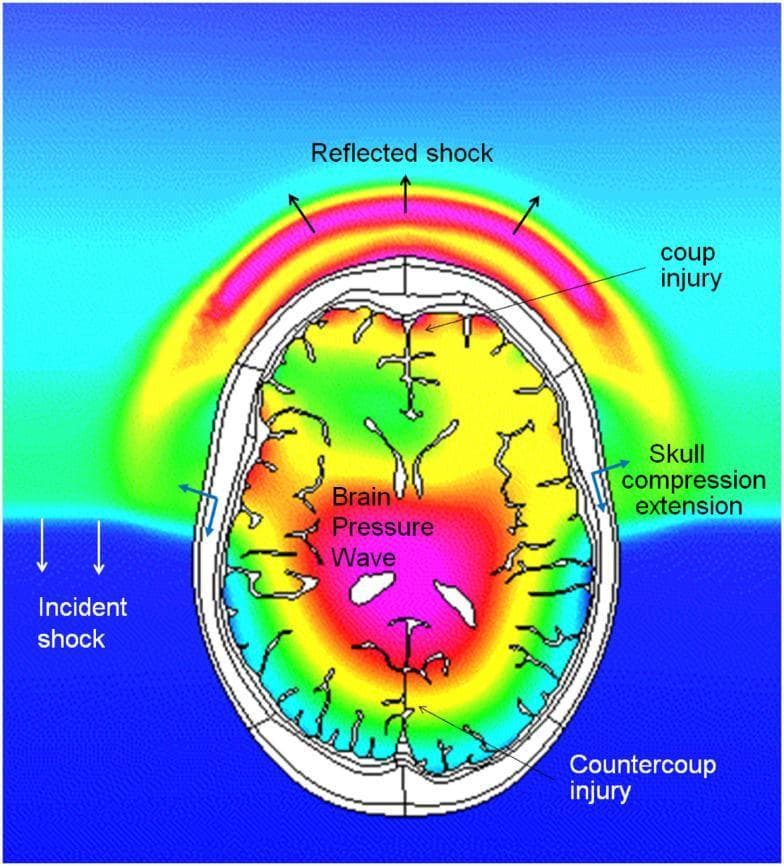 This pathophysiology diagram depicts a coupled simulation of Computational Fluid Dynamics (CFD) and Finite Element Method (FEM) biomechanics, illustrating a blast wave's interaction with a human head. The visualization shows an 'Incident shock' wave impacting the inferior-lateral aspect of the skull, resulting in a 'Reflected shock' wave arcing away from the impact site. The diagram highlights critical injury mechanisms including 'coup injury' at the site of impact and 'countercoup injury' on the diametrically opposite side of the brain. A color-coded pressure gradient within the cranial cavity shows the 'Brain Pressure Wave' propagating through the tissue, with high-pressure regions indicated in red/pink and lower-pressure zones in green. Structural mechanical responses are noted by labels for 'Skull compression extension.' This content is designed for advanced medical education in neurology and trauma surgery to explain the complex biomechanics of blast-induced traumatic brain injury (bTBI) and intracranial pressure dynamics.