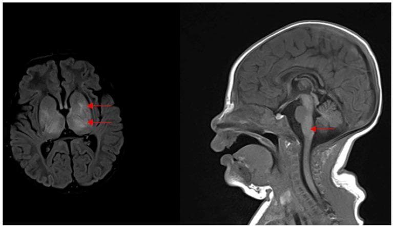 This diagnostic image consists of two brain MRI panels (axial and sagittal views) illustrating severe neonatal hypoxic-ischemic encephalopathy (HIE). The left panel is an axial T2-weighted or FLAIR sequence showing symmetric, bilateral hyperintensities (increased signal) within the basal ganglia (putamen and globus pallidus) and the thalamus, marked by red arrows. This 'basal ganglia-thalamus pattern' is characteristic of acute profound asphyxia. The right panel is a sagittal view showing an area of increased signal intensity and subtle swelling in the dorsal brainstem, specifically in the region of the pons/medulla junction near the vestibulocochlear nerve nuclei. These findings are clinically significant as they correlate with Stage III Sarnat HIE and are associated with profound sensorineural hearing impairment and poor neurological outcomes in neonates.
