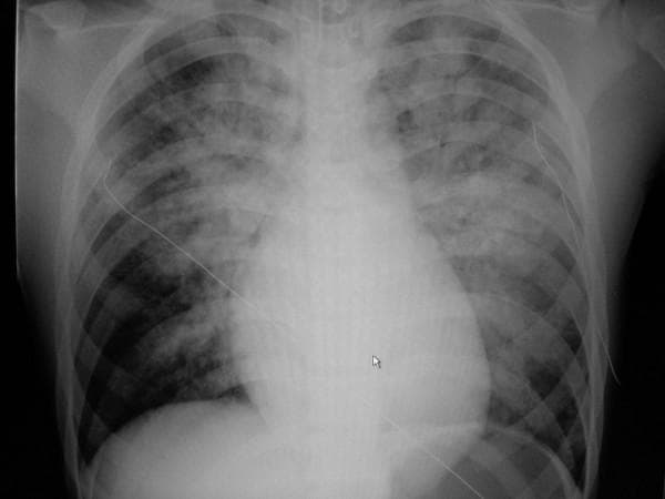 This diagnostic image is an anteroposterior (AP) chest X-ray demonstrating acute bilateral pulmonary edema. The radiograph reveals diffuse, hazy opacities and ill-defined infiltrates throughout both lung fields, exhibiting a characteristic perihilar 'bat-wing' distribution with prominent involvement of the upper and central lung zones. The lung parenchyma shows signs of alveolar consolidation and fluid accumulation. Cardiomegaly is evident, with an enlarged cardiac silhouette and indistinct borders. A thin, radiopaque monitoring line or catheter is visible crossing the right thoracic cavity toward the mediastinum. The mediastinal structures and bony thorax, including the clavicles and ribs, are otherwise unremarkable. This visual is clinically significant for students learning to identify radiological signs of heart failure and pulmonary congestion, as it highlights the hallmark features of cardiogenic pulmonary edema versus acute respiratory distress syndrome (ARDS).