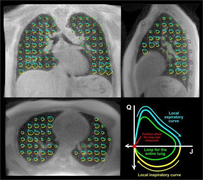 This composite diagnostic image showcases 3D Magnetic Resonance (MR) Spirometry data derived from a 3D Ultra-Short Echo Time (UTE) dataset of human lungs. The figure presents three anatomical planes: coronal (top left), sagittal (top right), and axial (bottom left), captured at the end of expiration. Superimposed across the lung parenchyma are regional flow-volume loops (Q vs. J). The yellow portions of these local loops represent the inspiratory phase, while the blue segments indicate the expiratory phase. Red dots denote the specific spatial points where each local loop was measured. A green loop is included at each location as a global reference, representing the flow-volume dynamics of the entire lung. The bottom right panel provides a legend for the color-coded phases and the Q (flow) and J (volume expansion) axes. These visualizations illustrate the spatial heterogeneity and regional variability of lung ventilation and respiratory mechanics during thoracic breathing, highlighting differences in loop size and shape across different lung regions.