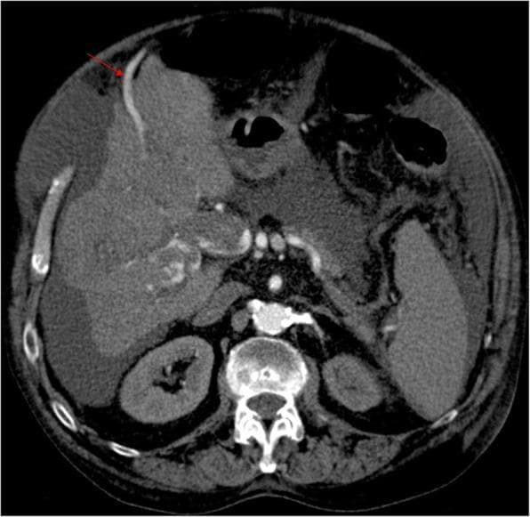 This axial multiplanar reconstruction (MPR) from an early arterial phase CT scan demonstrates advanced hepatic pathology and signs of portal hypertension. The liver parenchyma shows a nodular, heterogeneous contour consistent with cirrhosis. A primary finding is a tumoral portal vein thrombosis, appearing as a heterogeneous enhancing mass within the portal vein lumen, which suggests malignant infiltration (likely from hepatocellular carcinoma). Significant signs of portal hypertension are visible, including a prominent, repermeabilized paraumbilical vein (indicated by the red arrow) coursing anteriorly along the abdominal wall. There is also moderate ascites, visible as low-attenuation fluid surrounding the liver and filling the perihepatic space. The early enhancement of the recanalized paraumbilical vein in the arterial phase, combined with the portal thrombus, is highly suggestive of a malignant arterioportal fistula. This image serves as a clinical illustration of complications related to chronic liver disease and the secondary vascular remodeling occurring in the portal venous system.
