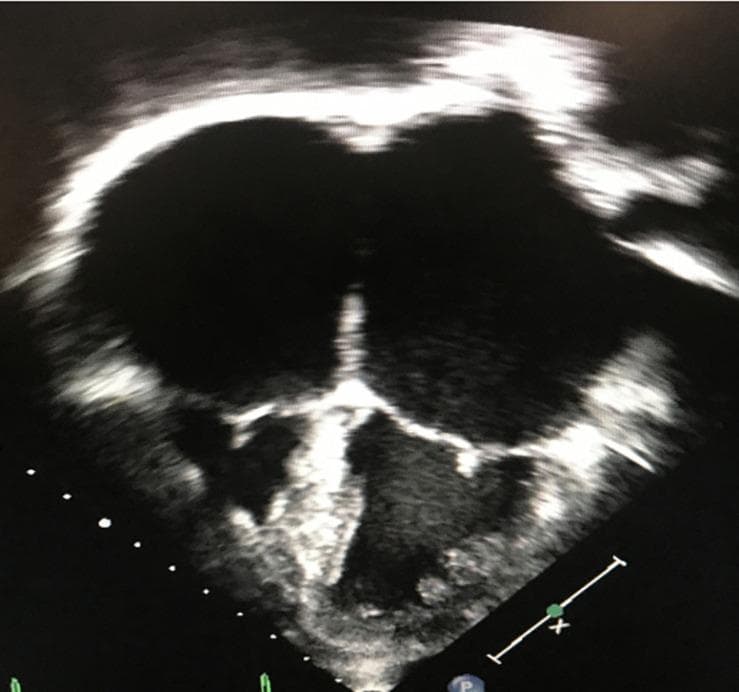 This diagnostic ultrasound image presents a 2D apical 4-chamber (A4C) view of the heart, characteristic of restrictive cardiomyopathy (RCM). The image highlights a classic 'mickey mouse' appearance due to massive biatrial enlargement. Both the left and right atria are severely dilated, occupying the majority of the cardiac silhouette. In stark contrast, the left and right ventricles appear disproportionately small, blunted, and restricted in volume. The ventricular walls exhibit a typical non-dilated morphology with preserved thickness, suggesting the restrictive physiology that leads to impaired diastolic filling and elevated filling pressures. This hallmark discrepancy between the diminutive ventricular chambers and the extremely enlarged atria serves as a primary educational example for differentiating restrictive patterns from dilated or hypertrophic cardiomyopathies. Key features visible include the central interventricular and interatrial septa and the atrioventricular valves, which separate the expansive atria from the small ventricular apex.