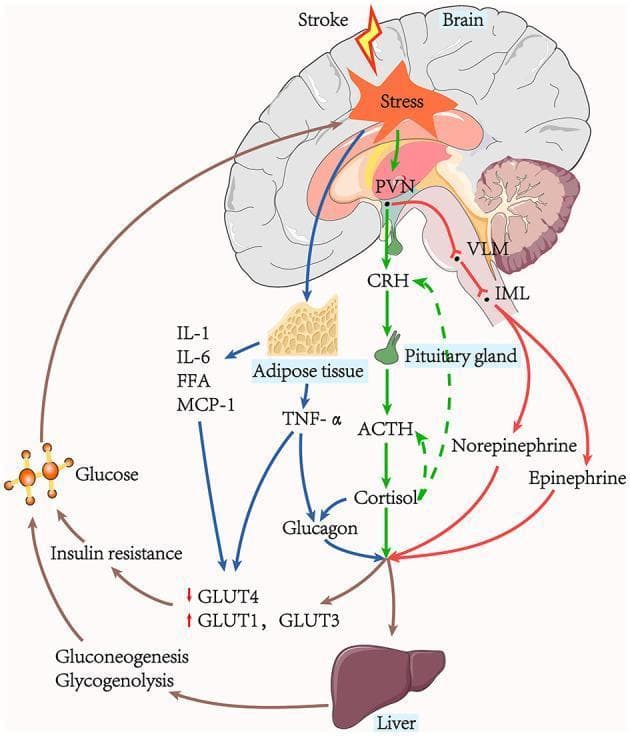 This pathophysiology diagram illustrates the complex physiological pathways leading to stress-induced hyperglycaemia (SIH) following an acute ischaemic stroke. The flowchart details two primary neuroendocrine axes: the Hypothalamic-Pituitary-Adrenal (HPA) axis and the sympathoadrenal system. Originating from the paraventricular nucleus (PVN) in the brain, the HPA axis triggers the release of Corticotropin-Releasing Hormone (CRH), stimulating the pituitary gland to release Adrenocorticotropic Hormone (ACTH), which results in cortisol production. Simultaneously, the neural pathway via the Ventrolateral Medulla (VLM) and Intermediolateral nucleus (IML) leads to the release of norepinephrine and epinephrine. These hormones, along with glucagon (stimulated by cortisol and TNF-α from adipose tissue), act on the liver to promote hepatic gluconeogenesis and glycogenolysis. The resulting elevated blood glucose contributes to insulin resistance, characterized by decreased GLUT4 and increased GLUT1 and GLUT3 expression. The diagram highlights a 'vicious cycle' where hyperglycaemia and pro-inflammatory factors (IL-1, IL-6, FFA, MCP-1) further exacerbate the initial brain stress response. This resource is suitable for medical education regarding metabolic complications in critical care and neurology.