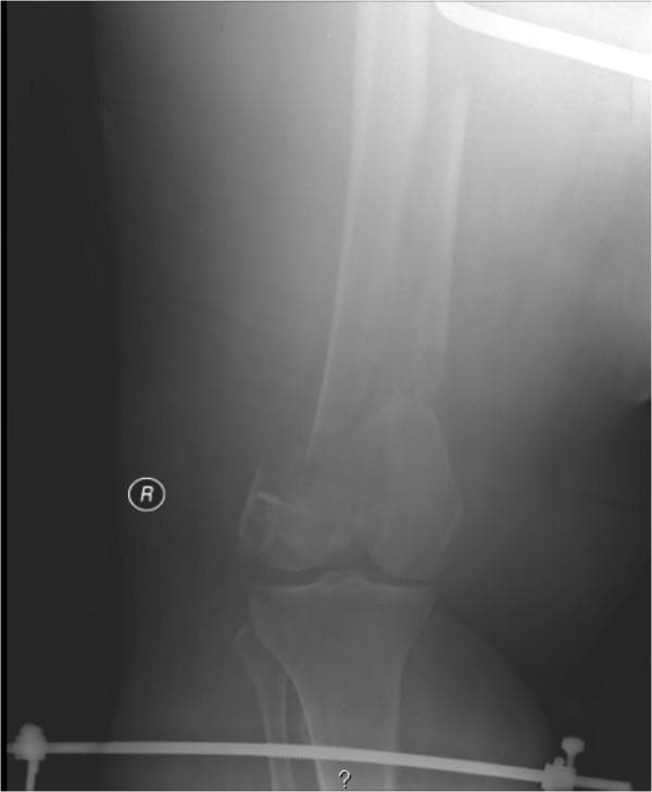 This diagnostic image is an anteroposterior (AP) radiograph of the right lower extremity, specifically the knee and distal femur, in an adult patient. The image demonstrates a complex, comminuted fracture of the distal femur. Key radiographic features include significant shortening and impaction of the femoral shaft into the supracondylar region, with a notable varus alignment of the distal fracture fragment. The distal femoral fragment is angled medially relative to the proximal femoral shaft. In the lower portion of the radiograph, elements of a skeletal traction system are visible, including a tibial traction pin (Steinmann pin) passing through the proximal tibia and secured to a metallic traction bow. The soft tissue envelope appears markedly thickened, consistent with clinical context of morbid obesity and traumatic swelling. This visual demonstrates the radiographic appearance of a high-energy femoral fracture and the application of skeletal traction as an initial orthopedic management strategy for length maintenance and fracture reduction.