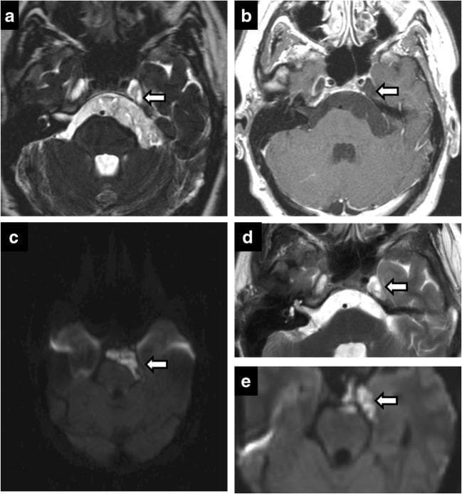 This set of neuroradiological images demonstrates an intracranial epidermoid cyst involving the left cerebellopontine angle (CPA) and Meckel's cave. (a) Axial T2-weighted MRI shows a lobulated, hyperintense mass expanding the left Meckel's cave and CPA cistern, causing mild mass effect on the adjacent brainstem. (b) Post-contrast T1-weighted MRI reveals the characteristic lack of internal enhancement within the lesion. (c) Diffusion-weighted imaging (DWI) displays classic restricted diffusion, appearing as a bright signal, which is diagnostic for an epidermoid cyst and distinguishes it from an arachnoid cyst. (d, e) Postoperative axial T2 and contrast-enhanced images show residual high-signal tissue within the left Meckel's cave, with focal areas of mild enhancement potentially representing postoperative inflammatory changes or small amounts of residual cyst wall. The case illustrates the typical multi-cisternal growth pattern and signal characteristics of epidermoid tumors in the skull base.