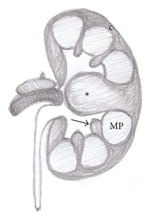This medical illustration is an anatomical diagram of a longitudinal cross-section of a human kidney, specifically demonstrating a common anatomical variant known as a hypertrophied column of Bertin. The diagram highlights several key structures: the outer renal cortex (labeled 'c'), multiple medullary pyramids (labeled 'MP'), and the renal columns located between these pyramids. A black arrow points to a normal-sized renal column, providing a baseline for comparison. In contrast, an asterisk (*) marks a hypertrophied column of Bertin, which appears as a significant, mass-like enlargement of cortical tissue extending deeply between the medullary pyramids. The illustration serves as an educational tool for distinguishing this benign pseudotumor from infiltrative solid renal lesions by showing its continuous nature with the surrounding cortex. The diagram also depicts the renal hilum, showing the entry/exit points for the renal vasculature and the proximal ureter.