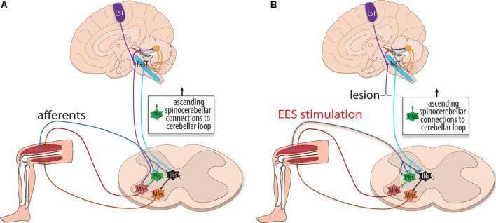 This medical schematic illustration depicts the internal motor copy circuitry and neural pathways involved in rehabilitation after spinal cord injury (SCI). The diagram is divided into two panels: (A) Healthy physiology and (B) Physiology following a lesion with Epidural Electrical Stimulation (EES). Key components include supraspinal networks like the Corticospinal Tract (CST, purple) and Reticulospinal Tract (ReST, blue) relaying motor commands from the brain to the spinal cord. Within the spinal cord, these tracts converge on interneurons (INs, black) and propriospinal neurons (PNs, green), which subsequently activate motoneurons (MNs, red/orange) to innervate the leg. Sensory afferents (red) return proprioceptive information from the leg to the spinal cord and cerebellum via the spinocerebellar tracts. In panel B, a lesion interrupts the primary descending tracts. However, EES stimulation is shown augmenting group Ia afferent activity, which spatiotemporally integrates with spared ReST fibers to reach the threshold required for interneuronal and motoneuronal activation. This illustrates the role of external neuromodulation in facilitating motor recovery by bypassing or reorganizing damaged descending pathways.