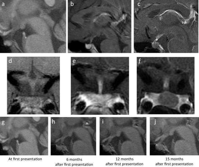 This composite of magnetic resonance imaging (MRI) frames focuses on the sellar and suprasellar regions, specifically the pituitary gland and stalk (infundibulum), over a 15-month progression. Panels (a, d) show sagittal and coronal non-contrast T1-weighted images at baseline, where the bright spot of the posterior pituitary is absent. Panels (b, e) demonstrate homogeneous gadolinium enhancement of the pituitary at initial presentation. By 15 months (c, f), contrast-enhanced images reveal a hypoenhancing area within the thickened pituitary stalk extending toward the posterior lobe. The bottom row (g-j) provides a serial sagittal plain T1-weighted timeline (at 0, 6, 12, and 15 months), illustrating the progressive morphological change from a thin, linear stalk to a significantly thickened, bulbous infundibulum. These imaging features—loss of the posterior bright spot, progressive infundibular thickening, and late-stage hypoenhancement—are indicative of an infiltrative or neoplastic process such as a central nervous system germinoma or lymphocytic infundibuloneurohypophysitis, clinically manifesting as central diabetes insipidus.