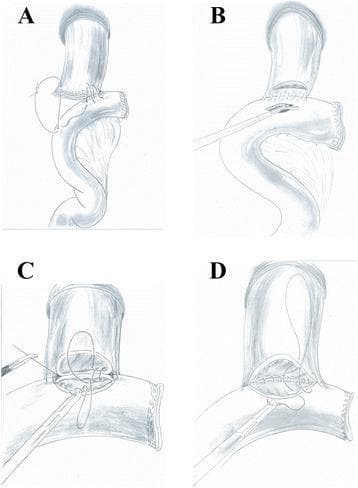 This medical illustration comprises four schematic panels (A-D) detailing the procedural steps of a hand-sewn end-to-side esophagojejunostomy, a critical reconstruction technique in gastrointestinal surgery.
Panel A illustrates the anchoring phase, where the jejunal loop is positioned against the esophageal stump and secured using serosal-muscularis interrupted sutures on the posterior aspect. Panel B depicts the preparation of the anastomosis site, showing precise incisions made into both the distal esophagus and the antimesenteric border of the jejunum using a surgical instrument. Panel C demonstrates the closure of the posterior wall of the anastomosis using full-thickness interrupted sutures to ensure a secure mucosal-to-mucosal apposition. Finally, Panel D shows the completion of the anterior wall closure using a full-thickness continuous suture technique, designed to create a watertight seal. This diagram serves as an educational resource for surgical residents and specialists to understand the suture logic and layer-specific targeting required for manual alimentary tract reconstruction.