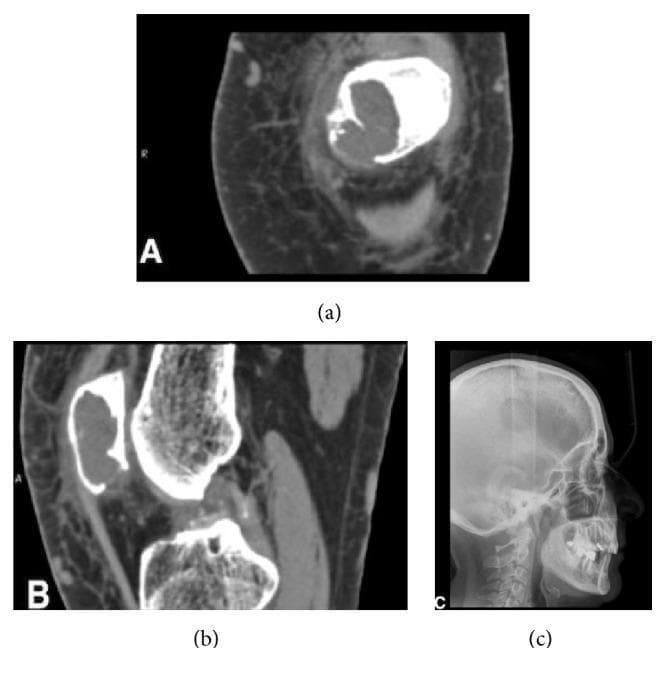 This composite of diagnostic images illustrates systemic skeletal manifestations of primary hyperparathyroidism. Images (a) and (b) are axial and sagittal CT scans of the left knee, revealing a prominent osteolytic, cyst-like lesion within the patella. The lesion exhibits a polylobate internal structure, regular borders, significant cortical thinning, and localized erosion, characteristic of a brown tumor. Image (c) is a lateral skull radiograph (X-ray) demonstrating the classic 'salt-and-pepper' appearance of the cranial vault. This sign is produced by multiple small, diffuse, punctate lucencies caused by trabecular resorption and replacement with fibrous tissue. Together, these findings highlight the generalized demineralization and focal bone lesions associated with hyperparathyroid-induced osteitis fibrosa cystica. The educational focus is on identifying systemic radiologic correlates of parathyroid pathology beyond common oral manifestations.