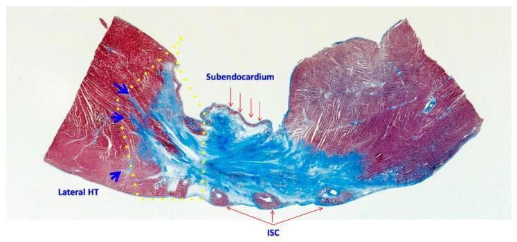 This diagnostic image is a low-magnification microscopy cross-section of myocardial tissue stained with Masson’s Trichrome, illustrating the histopathology of a healed myocardial infarction. The stain differentiates between collagenous fibrosis (blue) and viable myocardium/myocytes (red). The image highlights four distinct morphological zones: 1) A Central Dense Scar, characterized by a large, solid blue region entirely devoid of myocytes; 2) The Subendocardium, shown as the superficial blue layer lining the inner ventricular surface; 3) The Lateral Heterogeneous Tissue (HT), delineated by a yellow dotted line, which displays a transitional morphology where blue fibrotic strands (indicated by blue arrows) infiltrate and interdigitate with red viable muscle bundles; and 4) Intra-scar Channels (ISC), identified as small, circular red islands of surviving myocytes nested within the dense blue fibrotic region. This visual is used to demonstrate the complex structural substrate of cardiac scars, which can serve as pathways for reentrant ventricular tachycardia (VT) in clinical cardiology and electrophysiology.