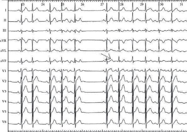 This diagnostic image is a 12-lead electrocardiogram (ECG) tracing demonstrating the 'P on T' phenomenon as a trigger for atrial arrhythmia. The tracing includes limb leads (I, II, III, aVR, aVL, aVF) and precordial leads (V1-V6). A specific arrow indicates an ectopic, non-conducted atrial premature contraction (APC). In this highlighted complex, the P-wave morphology is distinctly negative in leads I and aVL and positive in leads II, III, and aVF. This specific vector suggests an anatomical origin from the left superior pulmonary vein. The subsequent rhythm following the ectopic beat shows a transition into a paroxysmal tachyarrhythmia, likely atrial fibrillation, characterized by irregular QRS intervals and altered T-wave morphologies. The ECG serves as an educational example of how surface mapping of P-wave polarity can localize focal triggers for atrial fibrillation, aiding in pre-procedural planning for radiofrequency catheter ablation. Key concepts illustrated include atrial ectopy, pulmonary vein triggers, and the initiation of paroxysmal atrial fibrillation.
