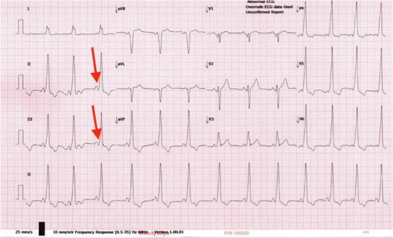 This diagnostic image is a 12-lead electrocardiogram (ECG) tracing demonstrating classic features of Wolff-Parkinson-White (WPW) syndrome. The primary finding is ventricular pre-excitation, characterized by a shortened PR interval (typically less than 120 ms) and a slurred upstroke of the QRS complex, known as a delta wave. Red arrows in leads II and III highlight these delta waves, which indicate early ventricular activation via an accessory pathway (Bundle of Kent). The QRS complexes are widened across multiple leads, particularly evident in the precordial leads V1-V3, and the rhythm is regular but appears tachycardic. The morphology of the QRS complexes in the limb leads and the prominent R waves in V1 are suggestive of an anteroseptal accessory pathway. This visual serves as a key educational resource for identifying pre-excitation patterns in cardiology and understanding the electrophysiological manifestations of accessory conduction pathways in pediatric and adult patients presenting with palpitations or syncope.